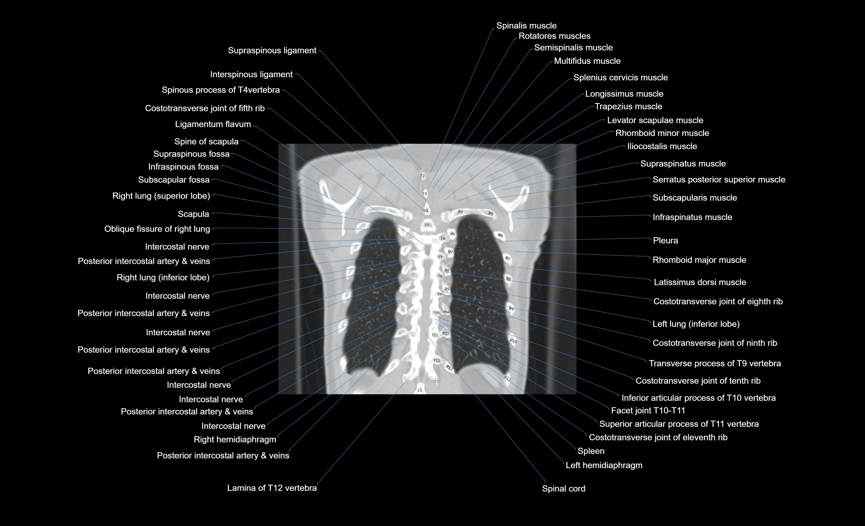CT chest (thorax) labelled coronal cross sectional anatomy radiology image-00022.webp